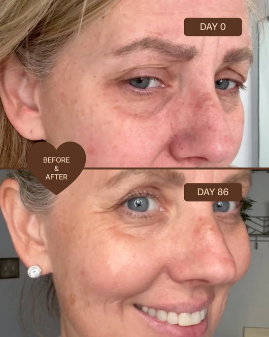 Thermara® Micro-Infusion System